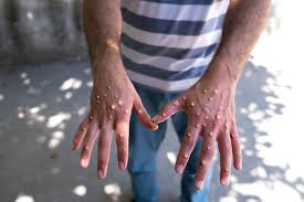 HABITANTES DE FRONTERA SUR DE MÉXICO PIDEN FILTROS SANITARIOS ANTE EL RIESGO DE MPOX